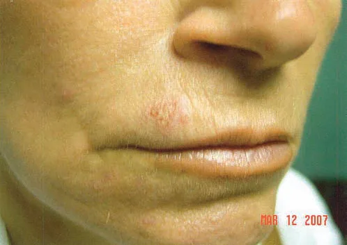 Placa eritematosa con pápulas y vesículas agrupadas en el labio cutáneo superior izquierdo, fotografiada a los pocos días de un tratamiento con láser fraccionado no ablativo sobre el labio superior. La lesión es pequeña y fácil de minimizar, y sin embargo es la misma reactivación que en un resurfacing completo puede infectar toda la superficie desepitelizada. Sadick 2008, figura 15.3.